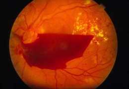 什麼是視網膜出血？如何治療？