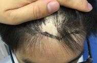 頭上有疤能不能植髮？疤痕植髮效果好不好？