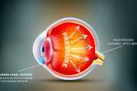 青光眼有什麼症狀？怎麼預防？