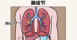 肺結節到底什麼原因引發的？瞭解幾個產生的原因，提前避免和預防