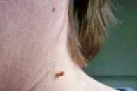 【警告】脖子、腋下莫名長出的"小肉粒"，是HPV感染？千萬別摳！