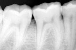 牙齒拍X線片有必要嗎？專家：沒有毫無理由的檢查！