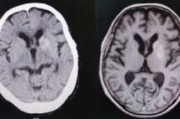 頭顱CT提示高密度影，是腦出血嗎？