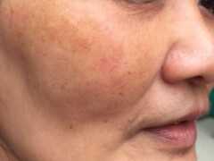 31歲女人臉上長斑點，醫美的細藥的，但是斑是沒淡成，身體卻越吃越