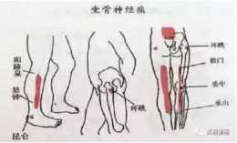 腰腿部疼痛位置的意義及治療