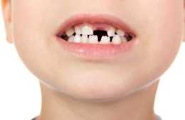 缺牙不補會有什麼危害？口腔科醫生為你細數6點，太詳細了！