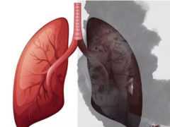上半身出現4個“訊號”，肺或已爛如漁網，若佔一個，早檢查肺CT