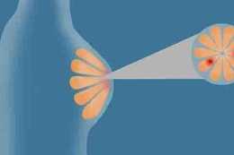 乳腺增生只有女性女生的專利嗎？男性會得乳腺增生嗎？