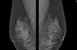 B超和X線鉬靶都沒發現的這種乳腺癌，是怎麼發現，怎麼處理的？
