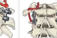 顱頸交界區畸形的手術治療方法