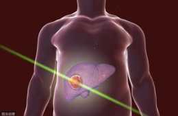 認清肝癌三大症狀 及時治療是關鍵