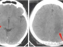 3種常見腦白質病CT表現