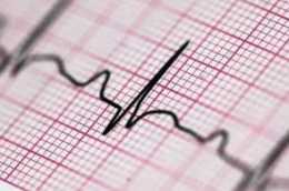 健哥說心臟有聲版｜心電圖顯示右束支傳導阻滯，是病嗎？