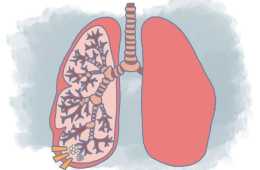 肺結節應該怎麼處理？要馬上切除嗎？