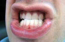 什麼叫磨牙症？3大病因不容忽視，注意5點可遠離磨牙