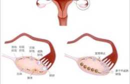 多囊卵巢如何調理？中醫教授指出四種類型，趕緊辨別下