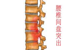 腰椎間盤突可以不治而愈嗎？哪些情況必須手術？願你早點明白