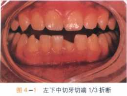 口腔臨床案例：牙外傷