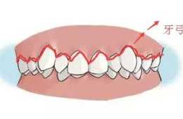 牙齒矯正中的擴弓是什麼？