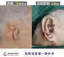 小耳畸形耳再造手術後耳朵有色差怎麼辦？