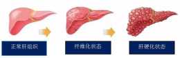 慢性肝病患者應定期檢測血清肝纖維化標誌物