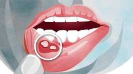 口腔潰瘍為什麼反覆發作？應該如何治療？