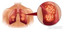 肺癌會有5個標誌，出現兩個以上，提示病情已經到了晚期