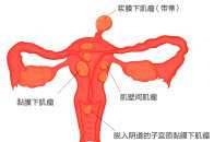 “消滅”子宮肌瘤的N種方法