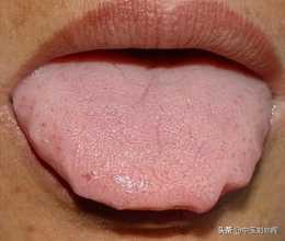 舌頭上有齒痕，都是脾虛嘛？醫生一次講清楚，7箇中成藥橫掃溼氣