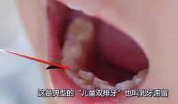 孩子換牙期，謹防發生“雙排牙”