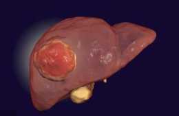 為何肝癌一發現就是晚期？這4個地方可以看出肝臟好壞，切莫忽視