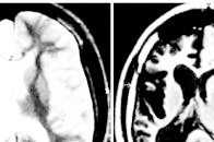 盤點影像學表現為一側腦萎縮的疾病，太實用了