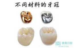牙冠有哪些材料，哪種比較好？