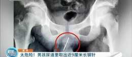 嚇人！南京13歲男孩尿血疼痛難忍，醫生從他尿道里取出近9釐米長鋼針！