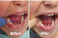 【口腔微學院】補牙能管幾年？補完牙後材料脫落？這些原因要注意！
