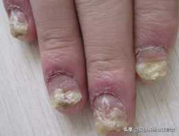 很多人誤把銀屑病甲損害當成灰指甲治療，鑑別和治療方法在這裡