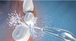 昌平洗牙到底傷不傷牙齒 一起了解下洗牙的好處和壞處