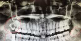 【口腔微學院】牙齒有炎症還是能拔牙呢？急性炎症期拔牙是有爭論的