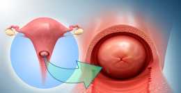 宮頸癌放療可造成骨髓再生不良，尤以白血球下降最為明顯